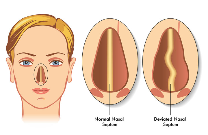 An illustration of a human face, a normal nasal septum, and a deviated nasal septum