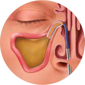 A graphic that depicts what happens to the sinus during balloon sinuplasty
