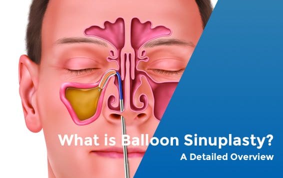 What is Balloon Sinuplasty Video Thumbnail